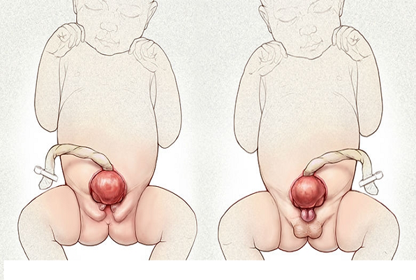 Exstrophy Bladder